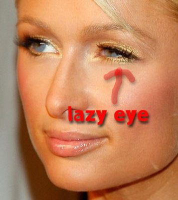  - lazy-eye