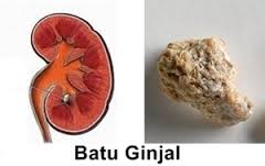 Hasil gambar untuk batu ginjal